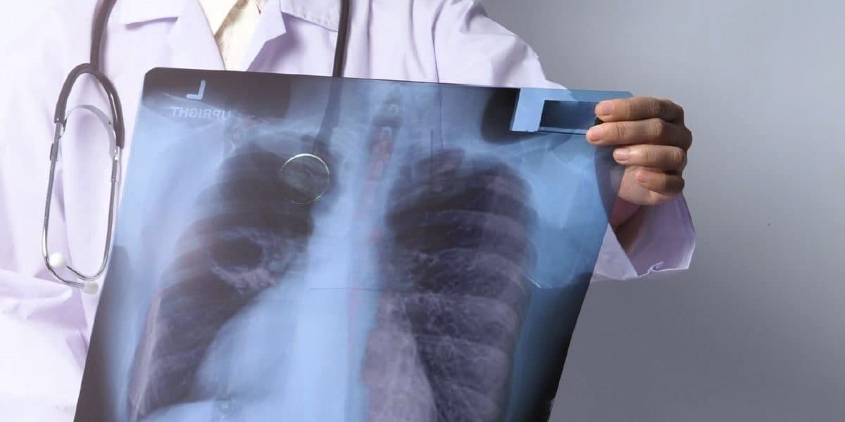 Alta incidência de tuberculose preocupa órgãos de saúde – Agência Brasil Central